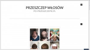 Po-przeszczepie.pl - Przeszczep włosów